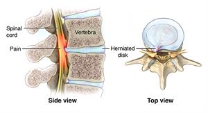 Side and top view of vertebra with herniated disc. 